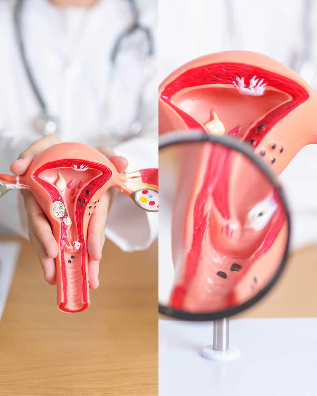 Illustration expliquant les différences entre l'endométriose et l'adénomyose chez la femme.
