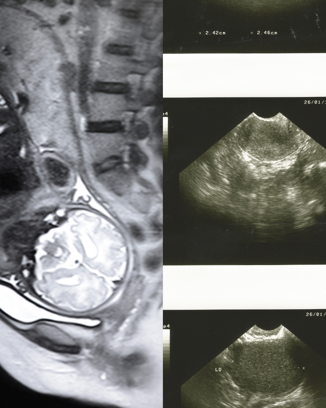 Médecin analysant une IRM pelvienne avec une patiente présentant des symptômes d'endométriose, illustrant les limites de l'imagerie dans le diagnostic.