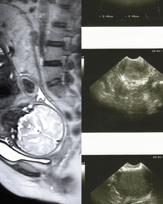 Médecin analysant une IRM pelvienne avec une patiente présentant des symptômes d'endométriose, illustrant les limites de l'imagerie dans le diagnostic.