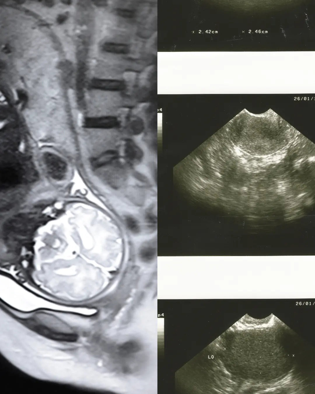 Médecin analysant une IRM pelvienne avec une patiente présentant des symptômes d'endométriose, illustrant les limites de l'imagerie dans le diagnostic.